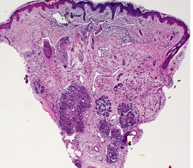Dermatopathology -Useful stains to help characterize vascular lesions