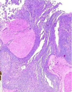Urogenital Pathology : Key recommendations in diagnosing bladder neoplasm